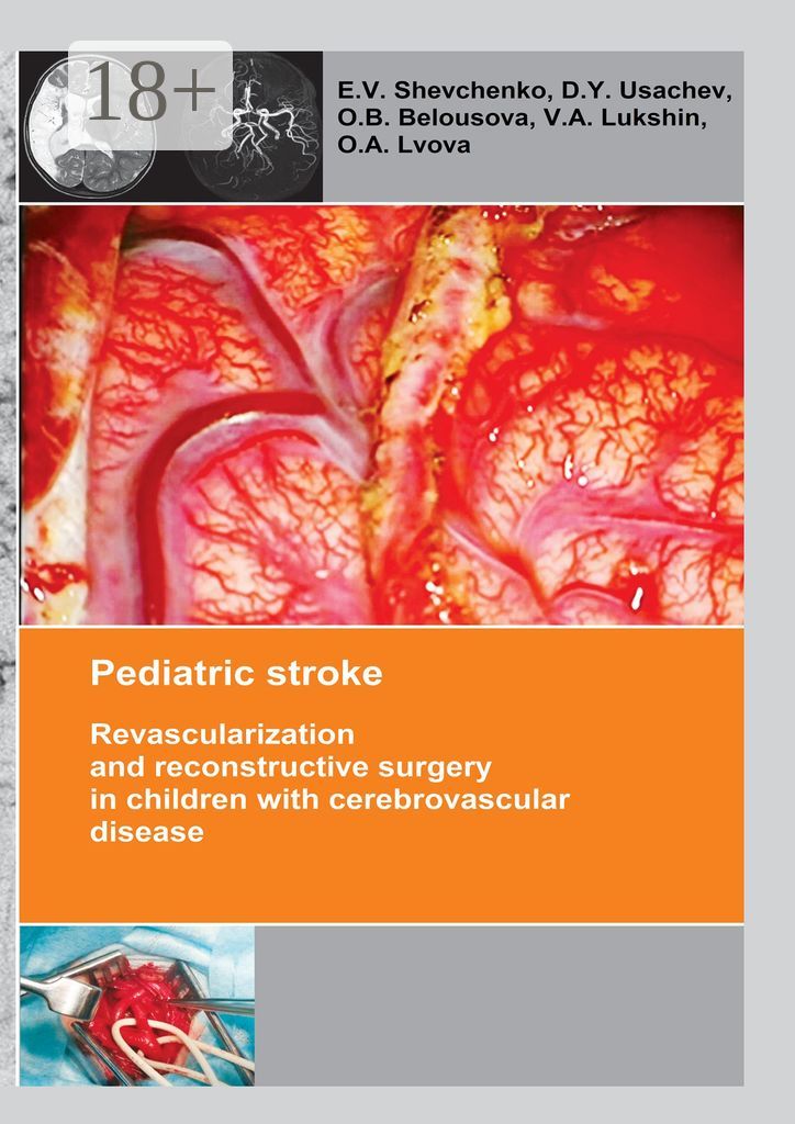 Pediatric stroke